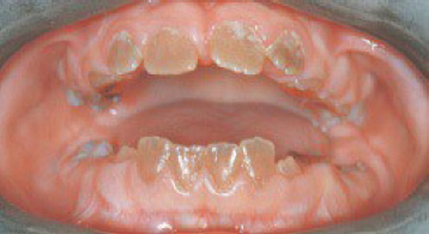 <p>dentinogenesis imperfecta.</p><p>Dentinogenesis imperfecta is a pathologic condition in which the family history plays a significant role in the diagnosis. Tetracycline staining is not a familial condition. Pulpal dysplasia is not a pathologic familial condition. Extrinsic staining is not a familial condition.</p>