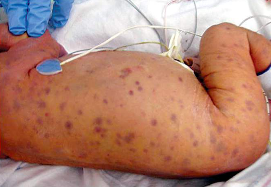 <p>In utero infection</p><p>Blueberry muffin rash</p><p>Deafness, cataracts, and cardiac disease (PDA)</p>