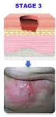 <p></p><p>Full-thickness skin loss with visible fat tissue; may have granulation tissue, slough, or eschar.</p>