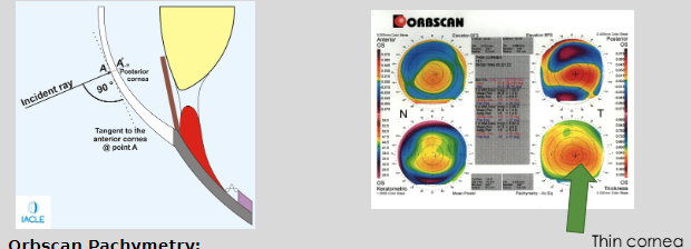 <ul><li><p>Non-invasive pachymetry method (Orbscan)</p></li><li><p>Measures CT perpendicular to the cornea</p></li><li><p>Ultrasonic pachymetry also measures perpendicularly</p></li><li><p>Orbscan thickness measurements are greater than manual ultrasonic pachymetry</p><ul><li><p>7–10% thicker (≈ 30 μm)</p></li></ul></li></ul><p></p>