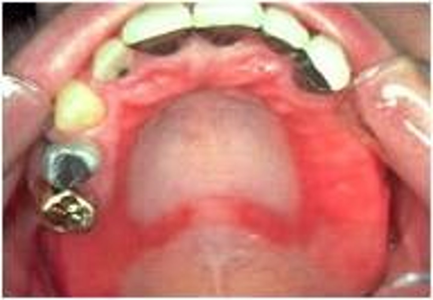 <p>AKA Denture Stomatitis; well-defined red plaque under prosthesis </p><p>• common locations: palate, maxillary ridge</p><p>• no pain</p>