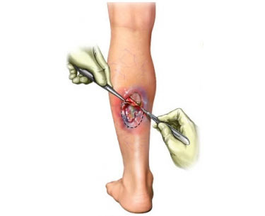 Removal of foreign matter or dead tissue from a wound