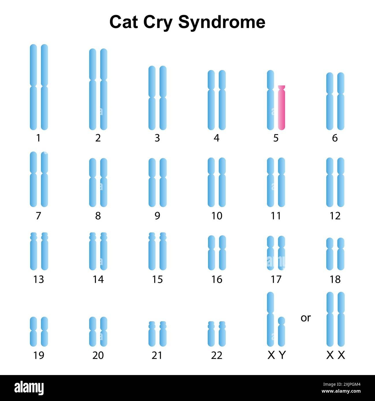 <p>Cri du chat Syndrome</p>