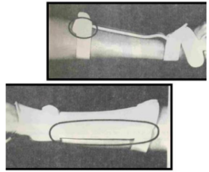 <p>Name this static splint component. What’s its function?</p>