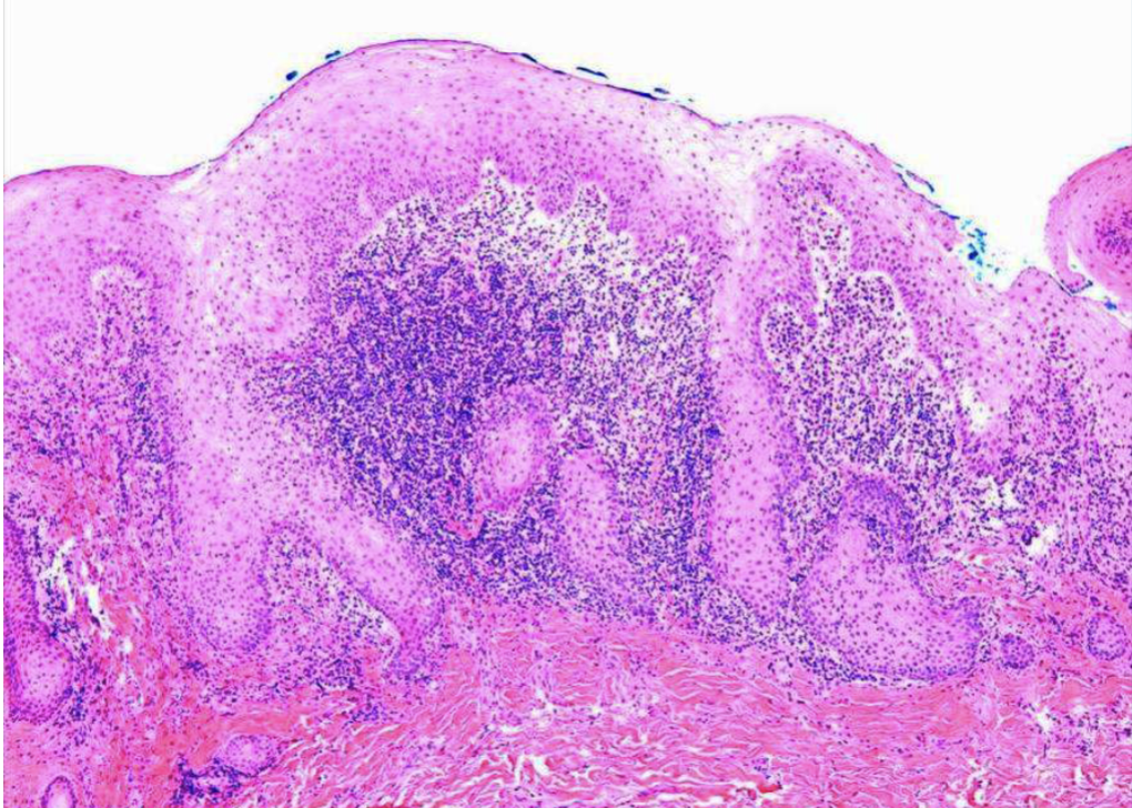 <ol><li><p>papillary growths on surface </p></li><li><p>may show pseudoepitheliomatous hyperplasia </p></li><li><p>sialadenitis </p></li></ol><p></p>
