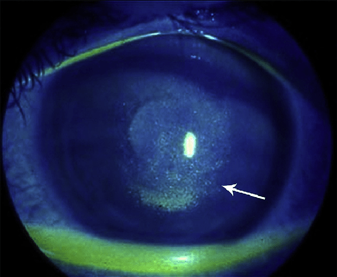 <p>Punctate Epithelial Erosions </p>