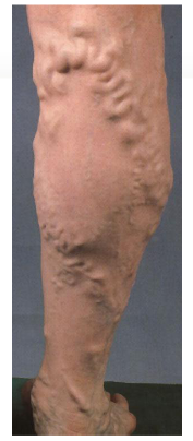 <ul><li><p><span><span>One-way valves malfunction</span></span></p></li><li><p><span><span>Allow backwards flow of blood and pooling</span></span></p></li><li><p><span><span>Generally, occurs in superficial veins in thigh and calf (saphenous vein – longest vein in the body)</span></span></p></li><li><p><span style="background-color: transparent;"><span>Common in legs/older adults</span></span></p></li></ul><p></p>