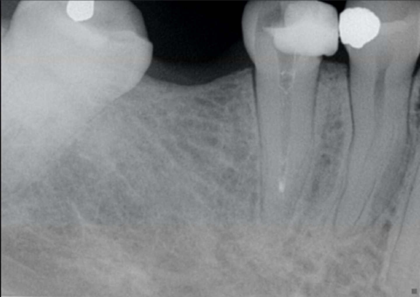 <p>ID the pulpal diagnosis:</p><p>- CC: "I was having pain in my tooth, my dentist did something and the pain went away, so I'm not sure why she sent me to you, the endodontist"</p><p>- Cold test: inaccurate</p><p>- Radiograph shows partial temp filling in pulp chamber with cotton replacing the pulp</p>
