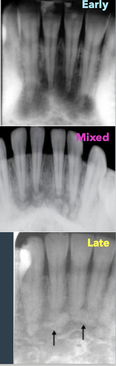 <ul><li><p>Early stage: Radiolucent (RL) lesions</p></li><li><p>Mixed stage: RL-RO appearance</p></li><li><p>Late-stage: Densely RO with a RL rim</p></li></ul><p></p>