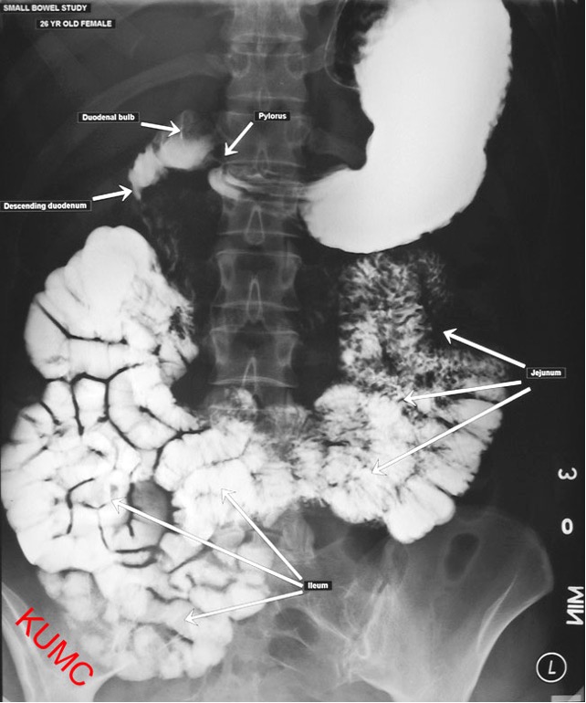 <p>small bowel (extension of UGI)</p>