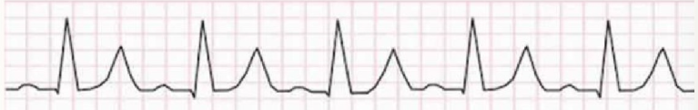 <ol><li><p>peaked/spiked T waves</p><ul><li><p>flat/absent P waves</p></li><li><p>prolonged QT interval</p></li><li><p>widened QRS complex</p></li></ul></li><li><p>cause = high potassium disrupts electrical signals</p></li></ol><p></p>
