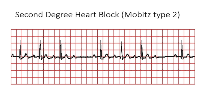 <p>2nd Degree Block Mobitz II</p>