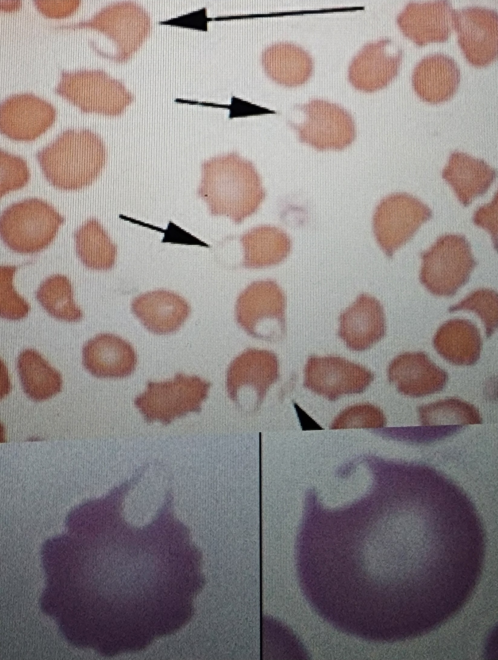 <p>Helmet, Blister, or Bite cells</p>