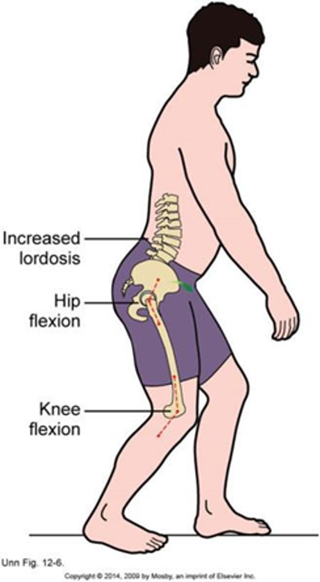 <p>Contractures will decreaseROM of the opposite motion in gait</p><p>Example: Hip flexion contracture will lead to decreased hip extension and decreased step length on the OPPosite side</p>