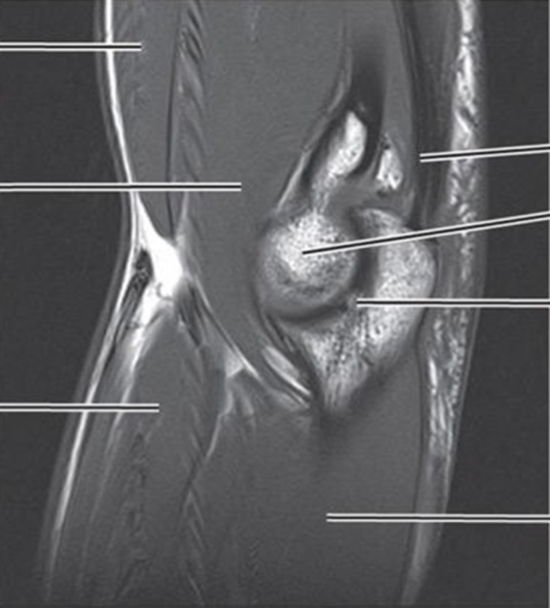 <p>- radial head<br>- humerradial joint<br>- humeroulnar jt</p>