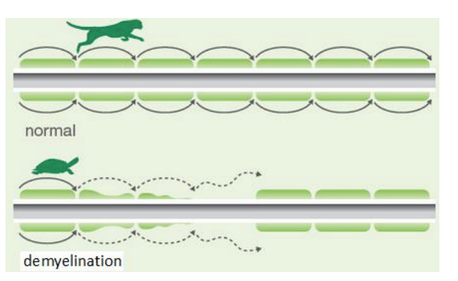 <ul><li><p>demyelinating disease = loss of myelin </p></li><li><p>loss of Saltatory conduction </p></li><li><p>signal transfer significantly slower</p></li></ul><p></p>