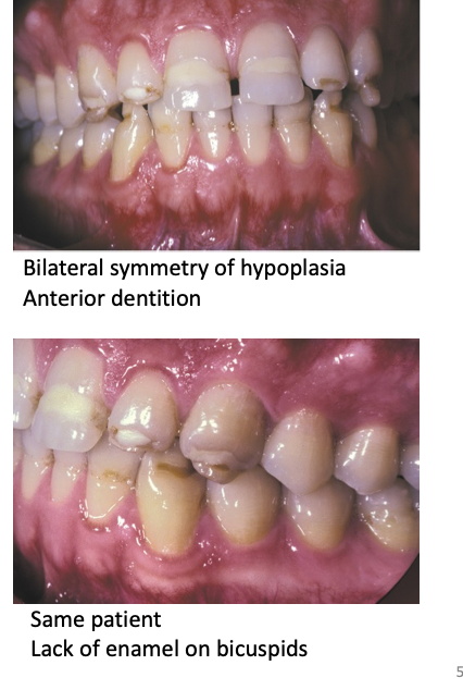 <ul><li><p class="p1"><strong><mark data-color="purple" style="background-color: purple; color: inherit;">Cause:</mark></strong><mark data-color="purple" style="background-color: purple; color: inherit;"> Systemic influences during tooth development</mark></p></li></ul><ul><li><p class="p1"><strong>Characteristic pattern:</strong></p><ul><li><p class="p1"><mark data-color="purple" style="background-color: purple; color: inherit;">Rows of pits or diminished enamel</mark></p></li><li><p class="p1"><mark data-color="purple" style="background-color: purple; color: inherit;">Bilateral and symmetrical enamel loss</mark></p></li><li><p class="p1"><mark data-color="purple" style="background-color: purple; color: inherit;">Defects’ location corresponds to </mark><strong><mark data-color="purple" style="background-color: purple; color: inherit;">developmental stage</mark></strong><mark data-color="purple" style="background-color: purple; color: inherit;"> of affected teeth</mark></p></li></ul></li></ul><p></p>