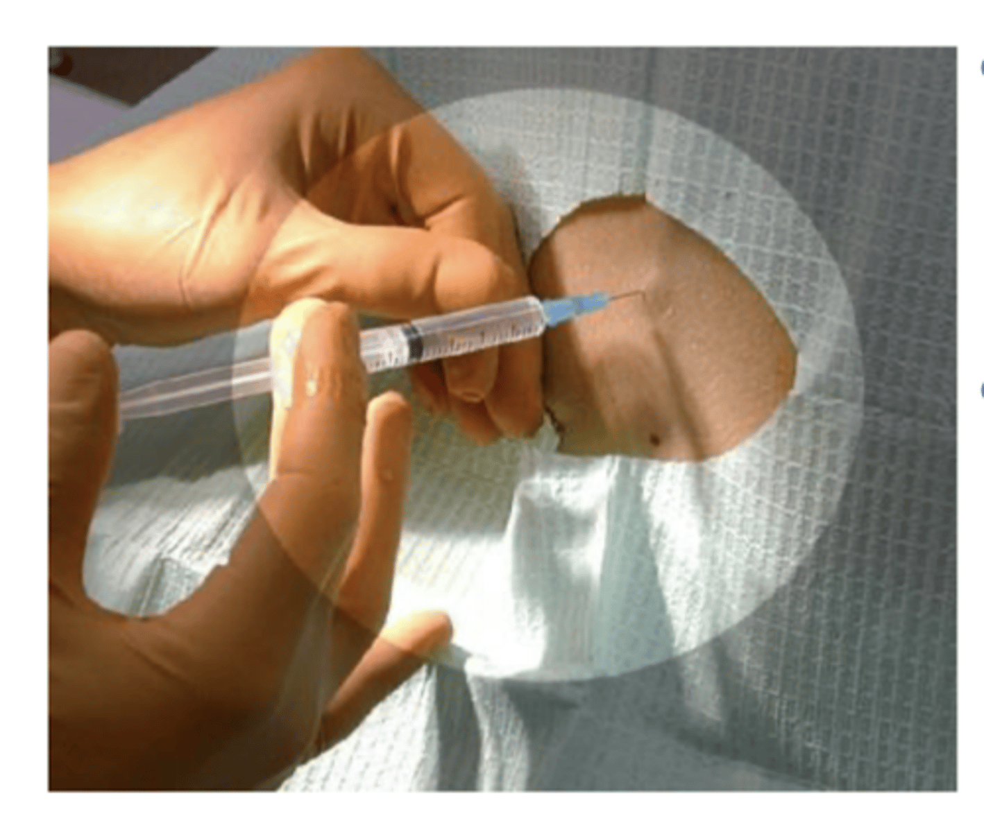 <p>Prevent or relieve pain without loss of consciousness or systemic effects</p>