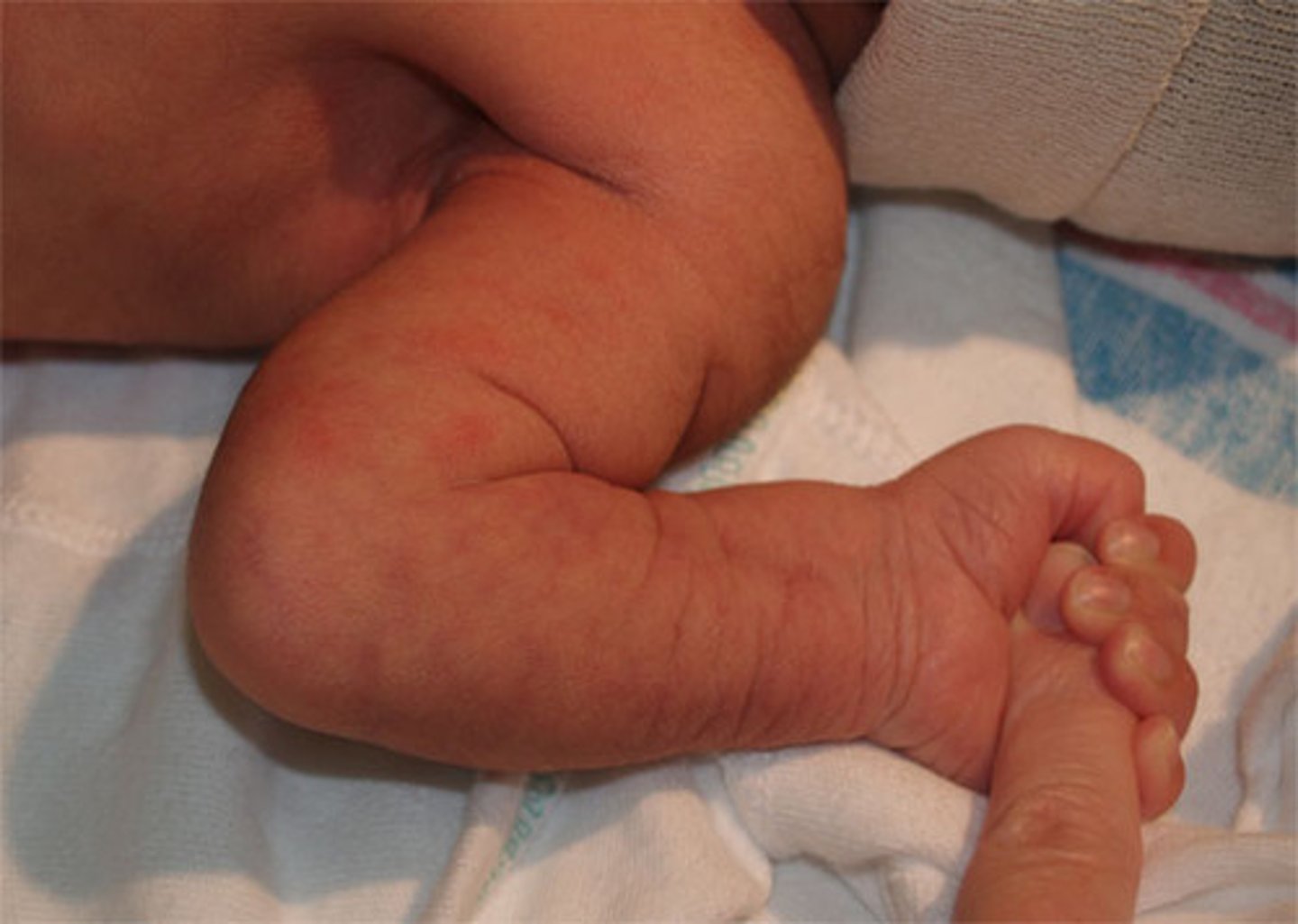 <p>lattice-like, bluish mottled appearance due to vasomotor changes in the dermis and subcutaneous tissue</p>