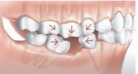 <ul><li><p>common problem </p></li><li><p>second molar in lower jaw tilts into space where first molar used to be. </p></li><li><p>Second molar being tilted makes it difficult or even impossible to create a satisfactory FPD cause the positional relationship is no longer allows for parallel path of insertion without interfering with adjacent teeth </p></li><li><p>If third molar present, it can further complicate issue. Tipped third molar’s mesial surface can block insertion path of a fixed partial denture </p></li></ul><p></p>