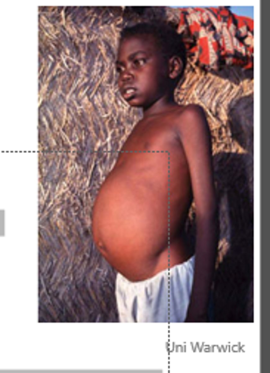 <p>•Involves endothelial tissue, liver, spleen and bone marrow</p><p>•caused by L.donovani and L.infantum (Old world) and L.infantum (New world)</p><p>•Fatal if left untreated</p><p>•Incubation period of 3-6 months</p><p>•fever, weight loss, lymphadenopathy, anemia; later hepatosplenomegaly with darkening of skin</p><p>•Cause of death is a compromised immune system => co-infections</p>