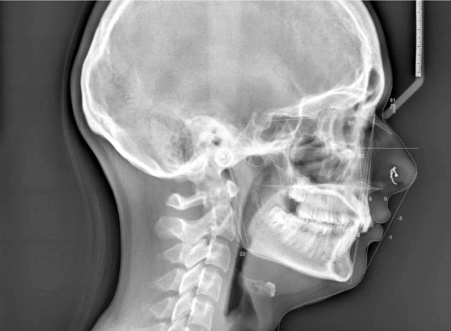 <p>What type of skeletal malocclusion is this patient?</p>