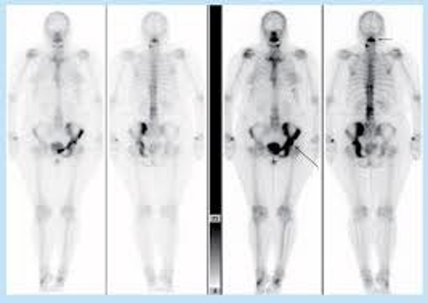 <p>enlargement of an affected bone, increased opacity of involved bone, along with disorganized and coarsened trabecular pattern</p>