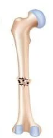 <p>a bone that is broken in at least 2 places, caused by severe trauma<br>-will need surgery to repair bone and recovery can be a year+</p>