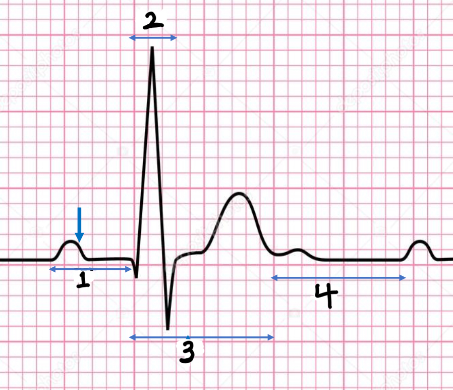 <p>Time from beginning of QRS complex to the end of the T wave </p>