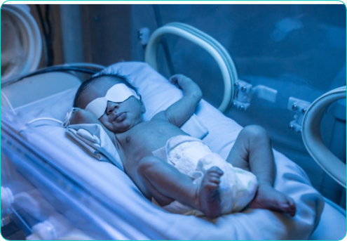 <p><strong><span>-Common in healthy newborns</span></strong></p><p><span>-improper</span><strong><span> bilirubin uptake and conjugation</span></strong></p><p>-<strong>poor intake or dehydration</strong></p><p>-<strong>Ass. With hemolytic disease, metabolic and endocrine disorders, liver abnormalities, infections</strong></p><p>-<strong>Tx: phototherapy.</strong></p>