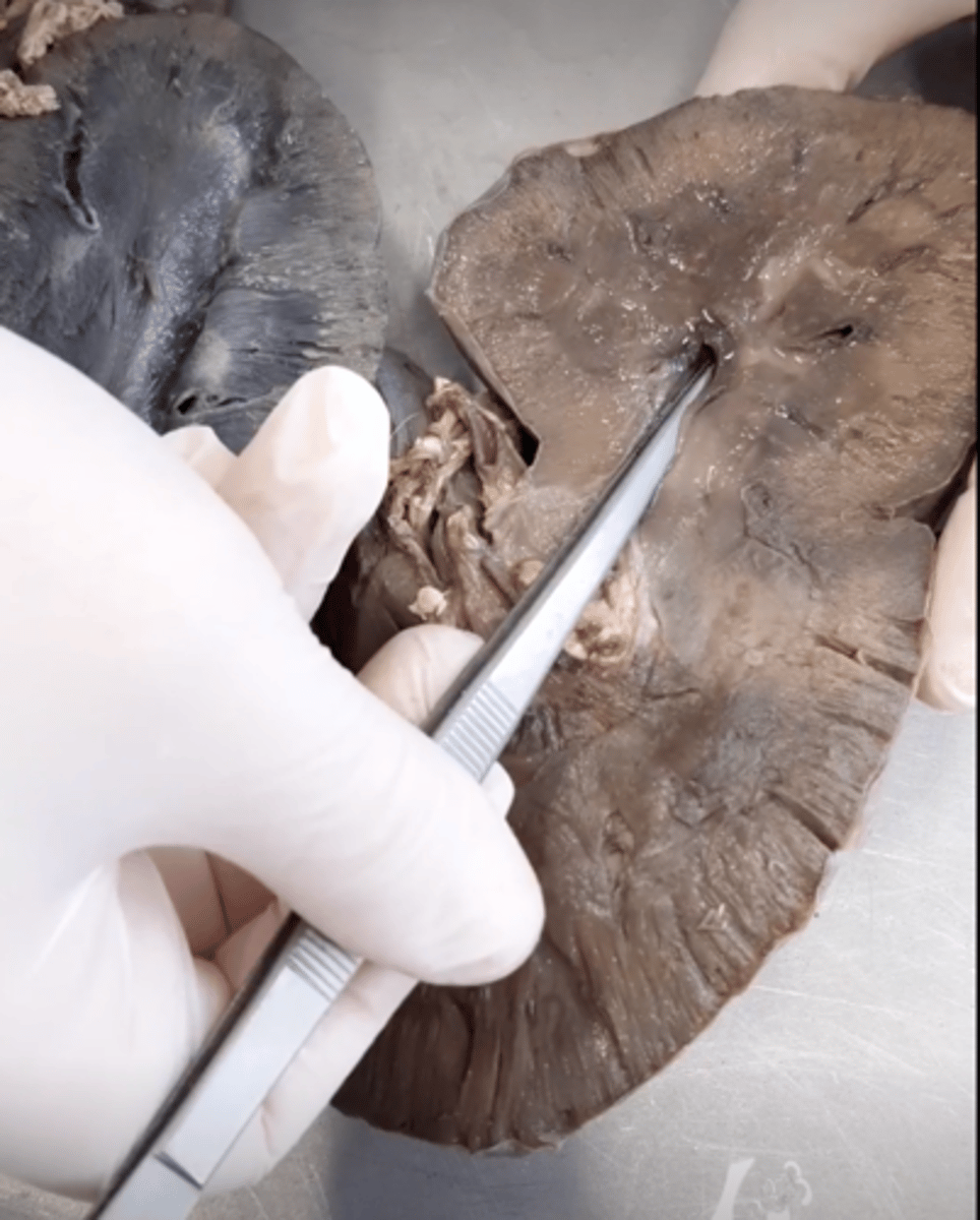 <p>What the forceps lead to</p>