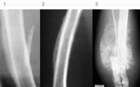 <ul><li><p><strong>Healing</strong> process in response to injury with Sharpey’s fibers</p></li><li><p><strong>Solid / Homogeneous</strong></p><ul><li><p><strong>Periosteum is lifted</strong> and new bone has filled space beneath it</p></li><li><p>well defined</p></li></ul></li><li><p><strong>Lamellated</strong></p><ul><li><p><strong>alternating</strong> <strong>opacities</strong></p></li><li><p>cyclic <strong>ongoing</strong> processes</p></li><li><p>Active, <strong>aggressive</strong> lesions</p><ul><li><p>Osteomyelitis, fungal disease, neoplasia</p></li></ul></li></ul></li><li><p><strong>Spiculated</strong></p><ul><li><p>spicules at <strong>right angles</strong> with the bone</p></li><li><p><strong>pus</strong>, neoplastic cells between spicules</p></li><li><p><strong>Form along Sharpey’s fibers</strong></p></li><li><p><strong>aggressive </strong>process</p><ul><li><p>infection, neoplasia, fungal</p></li></ul></li></ul></li><li><p><strong>Amorphous “wispy”</strong></p><ul><li><p>Looks like anything</p></li><li><p><strong>Aggressive </strong>process</p><ul><li><p>neoplasia</p></li></ul></li></ul></li><li><p><strong>Codman’s Triangle</strong></p><ul><li><p><strong>Lifting </strong>of periosteum by radiolucent cells at lesion <strong>edge</strong></p></li><li><p><strong>aggressive</strong> processes</p><ul><li><p>osteomyelitis, neoplasia</p></li></ul></li></ul></li></ul><p></p>