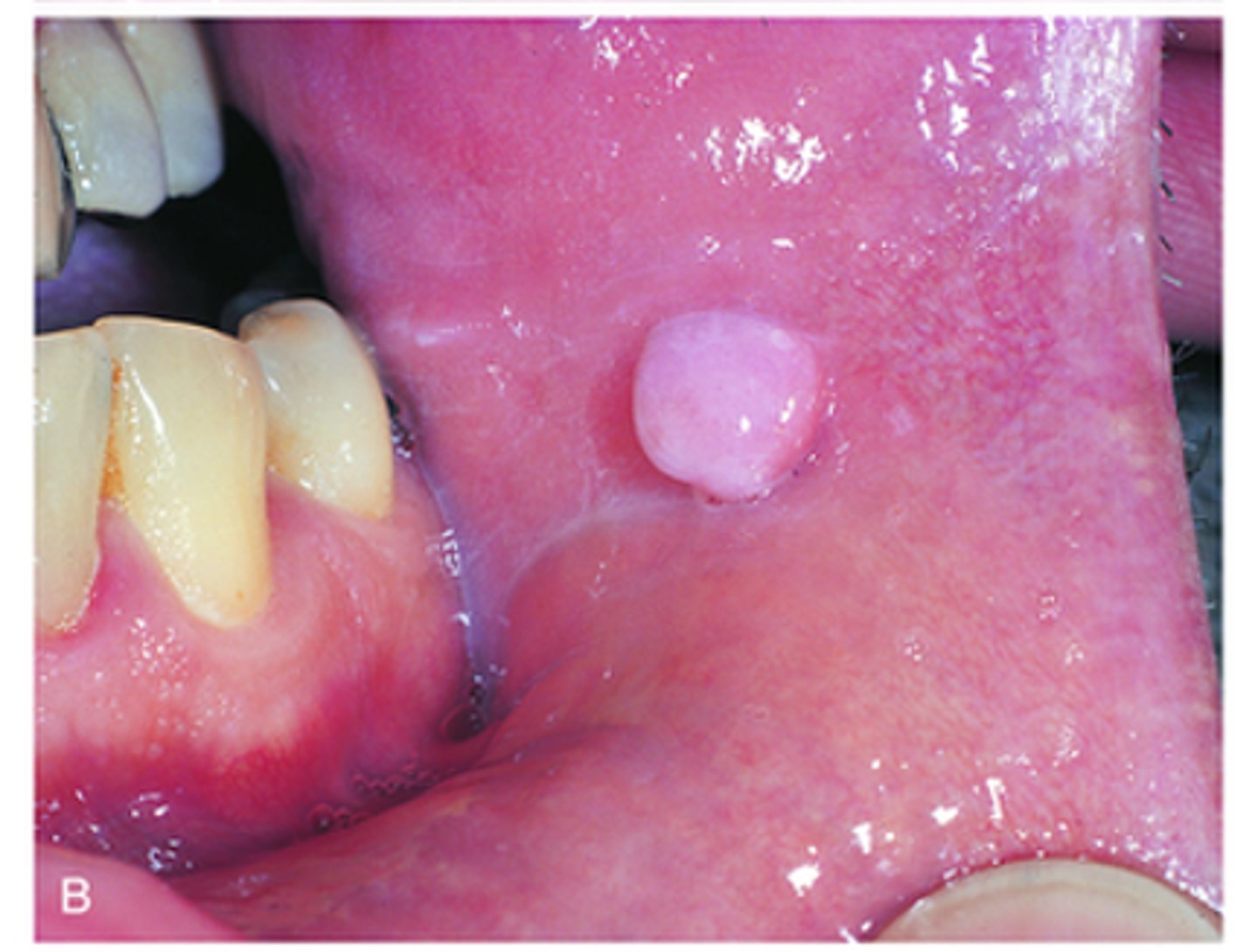 <p>Most common mass on the gingiva; Caused by trauma: Broad-based, usually small lesion, less than 1 cm in diameter</p>