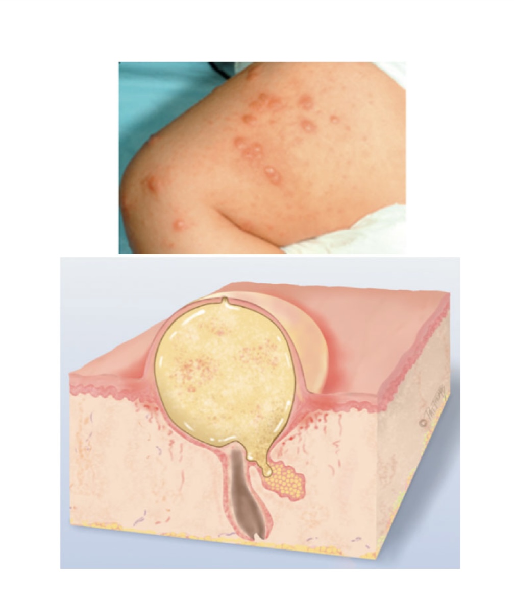 <p>Turbid fluid (pus) in cavity (acne)</p>