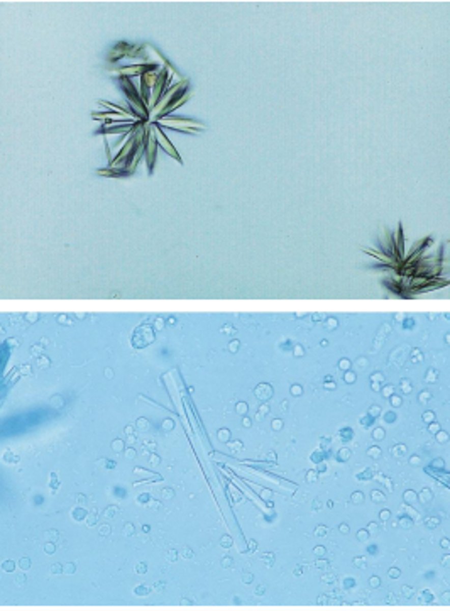 <p>Seen in patient treated for UTI</p><p></p><p>Possibility of <span class="bgP">tubular damage</span> if crystals are forming in the nephron</p><p></p><p>Shapes and Color: needles, rhombics, whetstones, sheaves of wheat, and rosettes with colors ranging from colorless to yellow-brown</p>