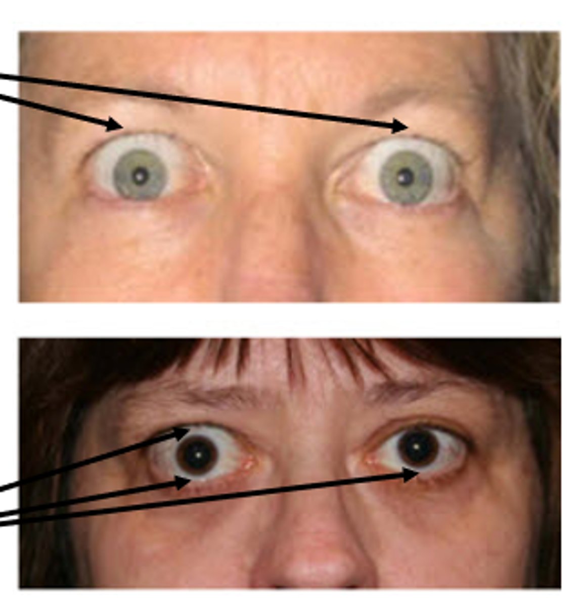 <p>retraction of of upper lid on primary gaze</p>