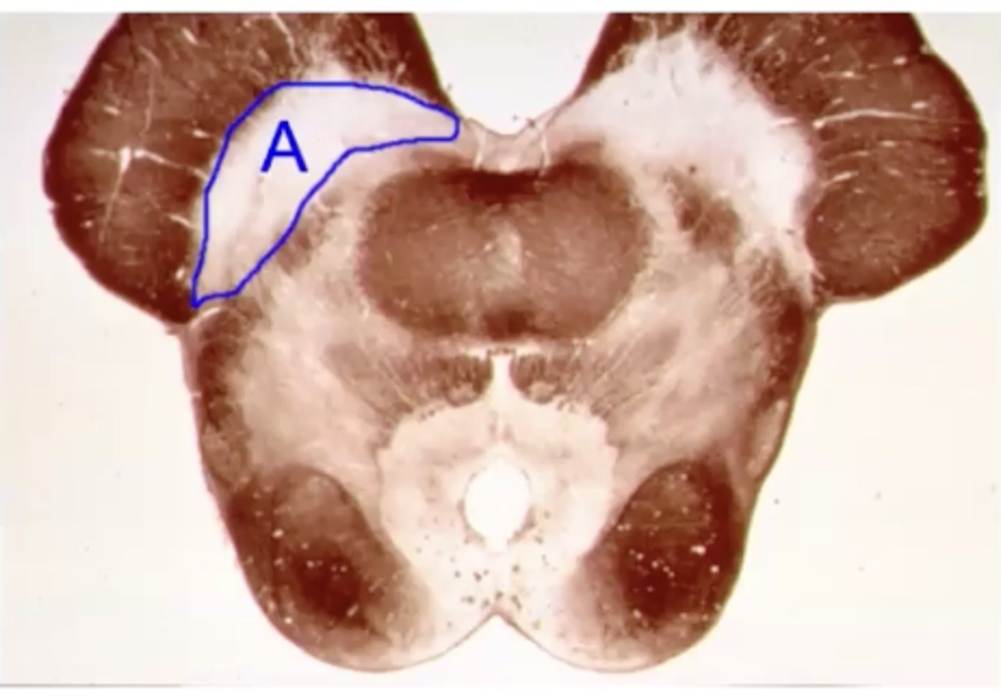 <p>name the clinical condition when A is lesioned</p>