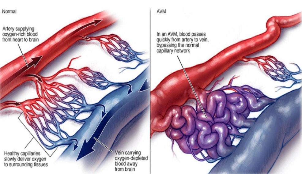 <ul><li><p>Tangle of blood vessels that irregularly connects arteries and veins </p></li><li><p>Result from the development of irregular connections between arteries and veins </p></li></ul><p></p>