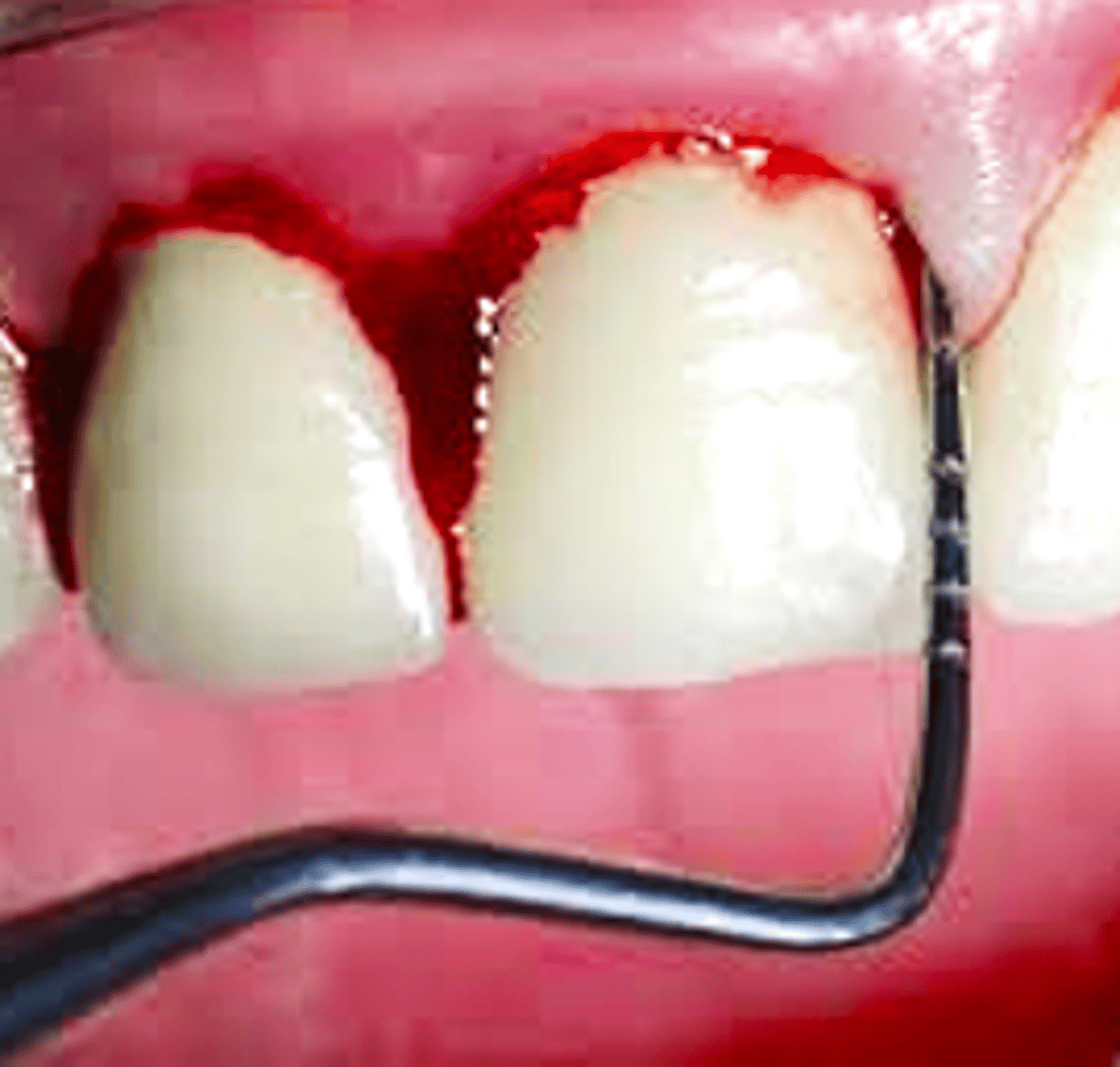 <p>your implant patient presents with presence of peri-implant soft tissue signs of erythema, edema, BoP and no additional bone loss following initial healing. What is the diagnosis?</p>