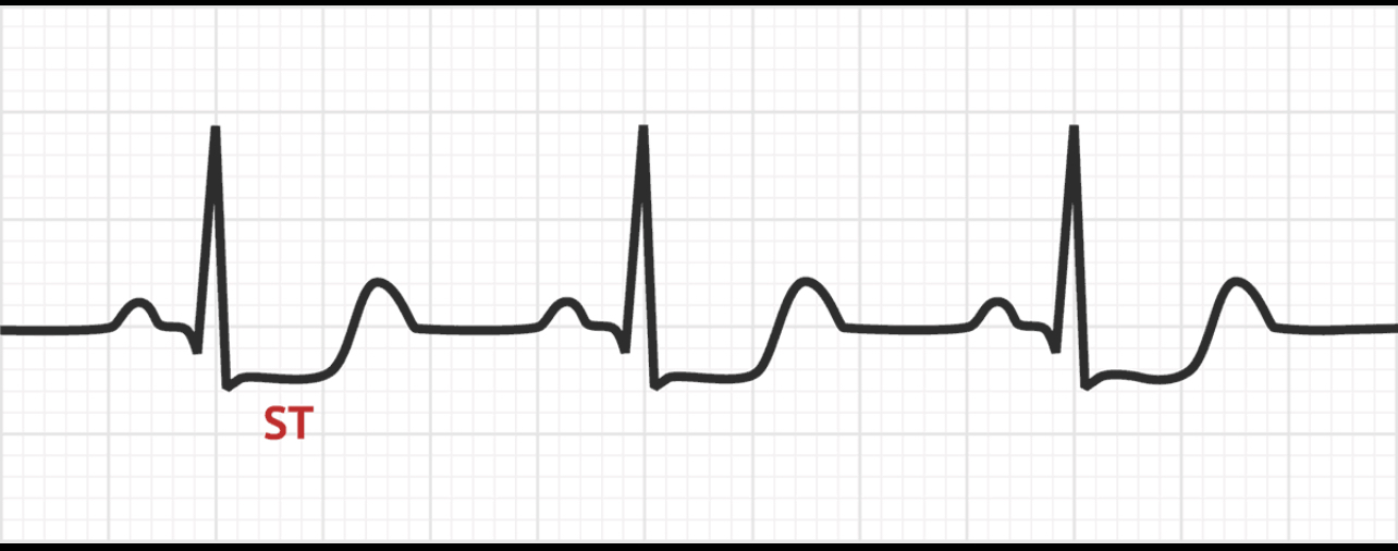 <p>ECG:</p><p>Wide spread ST depression</p><p>ST elevation in aVR</p>