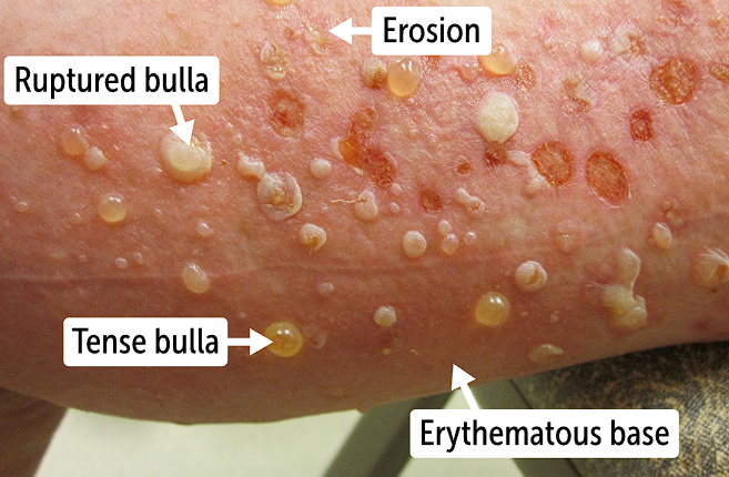 <p><span>presents with urticaria-like lesions, which are <strong>erythematous, pruritic, and edematous wheals.</strong> </span></p><ul><li><p><span>bullae seen on the skin in bullous pemphigoid are <strong>severely pruritic 1- to 3-cm blisters on an erythematous base</strong>. These bullae are tense and therefore <strong>negative for the Nikolsky sign.</strong></span></p></li><li><p><span>Unlike PV that is positive but when eroded blisters rupture, they are similar to PV with <strong>moist, erythematous base and crust formation</strong></span></p></li></ul><p></p>