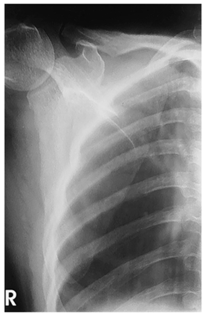 <p>- Breathing technique (optional)</p><p>- CR to midscapula</p><p>- Entire scapula demonstrated</p><p>- Lateral border of scapula free of ribs and lungs</p><p>- Optimal exposure factors</p>