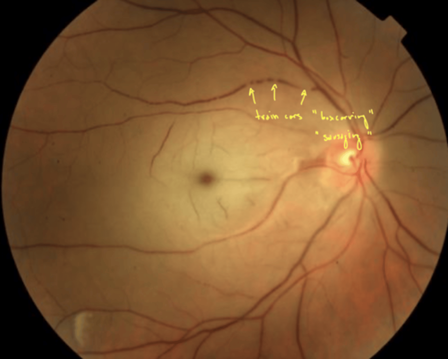 <p>retinal tissue is white → no blood supply</p><p>fovea is still red because blood supply from choroid unaffected</p>