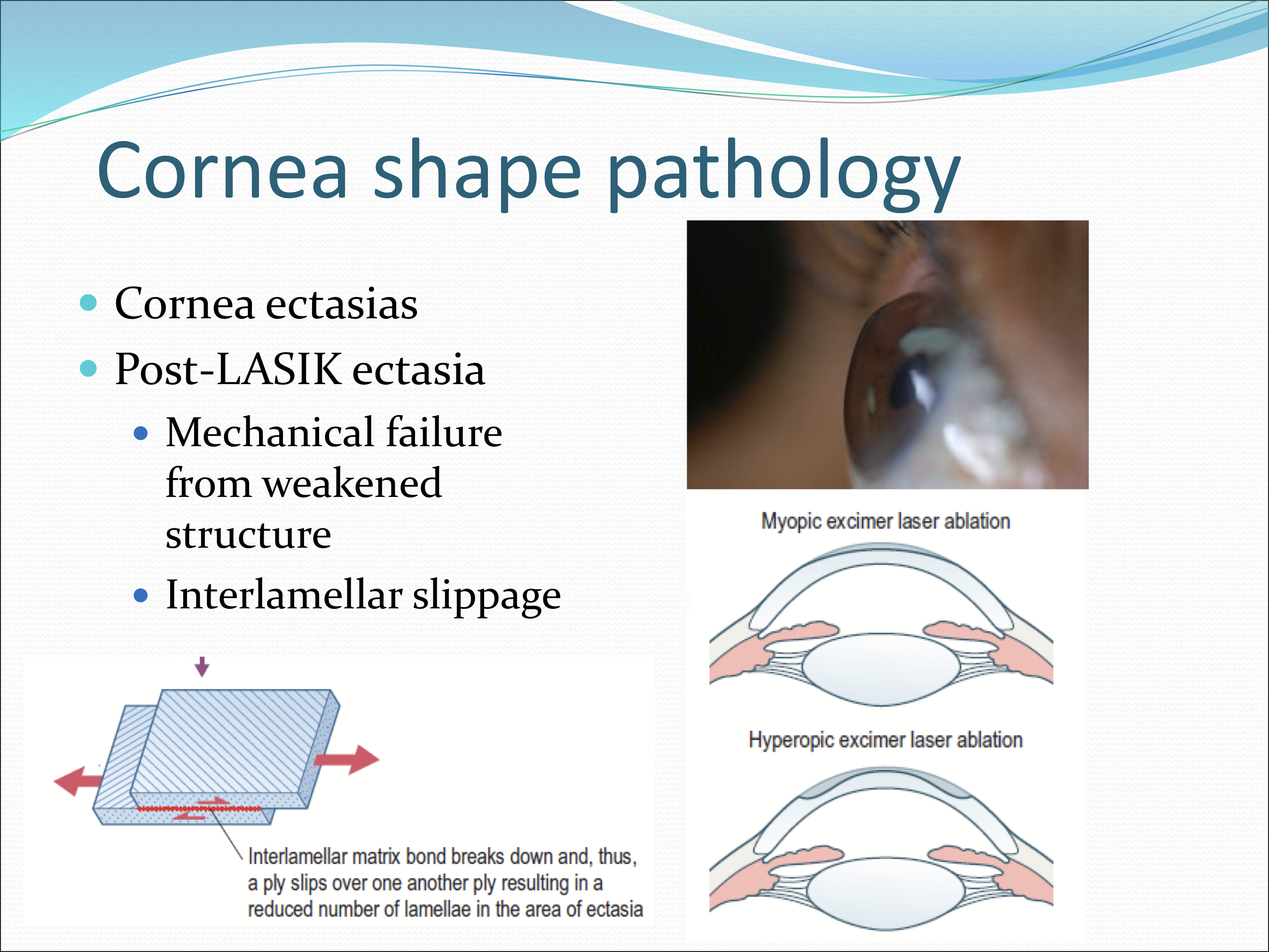 <p>The intrerlamellar slippage from mechanical failure of the cornea due to a weakened structure</p>