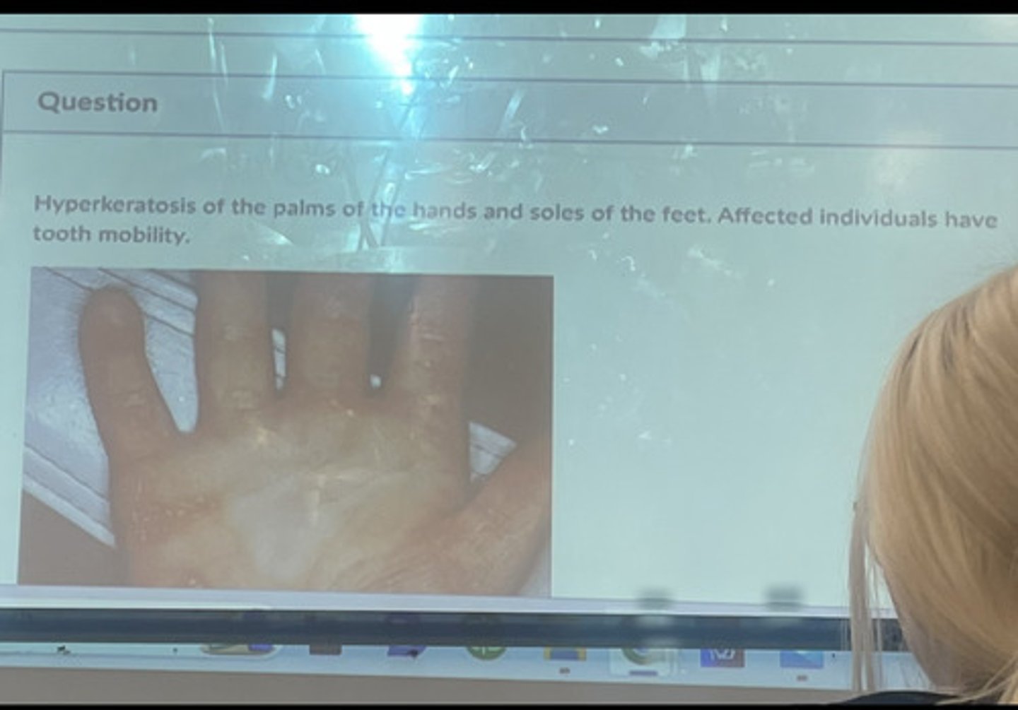 <p>Hyperkatosis of the palms of the hands and soles of the feet. Affected individuals have tooth mobility.</p>