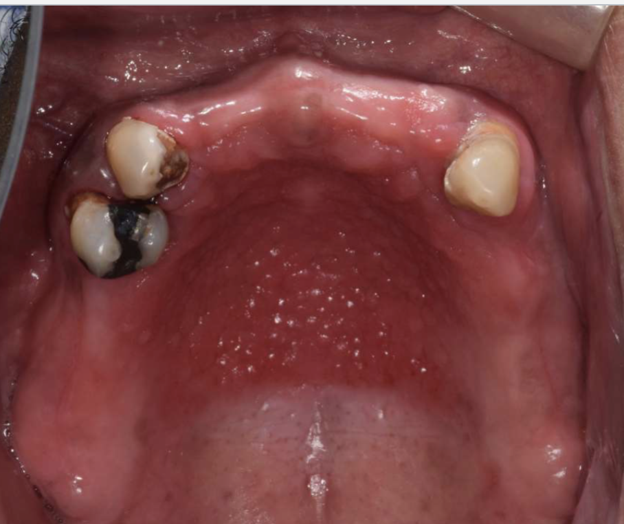 <ol><li><p>hard palate beneath denture base </p></li><li><p>pink/red pebbly mucosa </p></li><li><p>erythema suggests secondary candidal infection</p></li></ol><p></p>