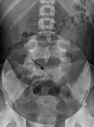 <p>a mild, insignificant form, in which there is a splitting of the bony neural canal at the L5 or S1 level.</p>