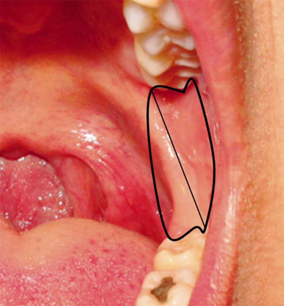 <p>Tissue that extends from the junction of the hard and soft palates down to the mandible and stretches upon opening (RAPHE)</p>