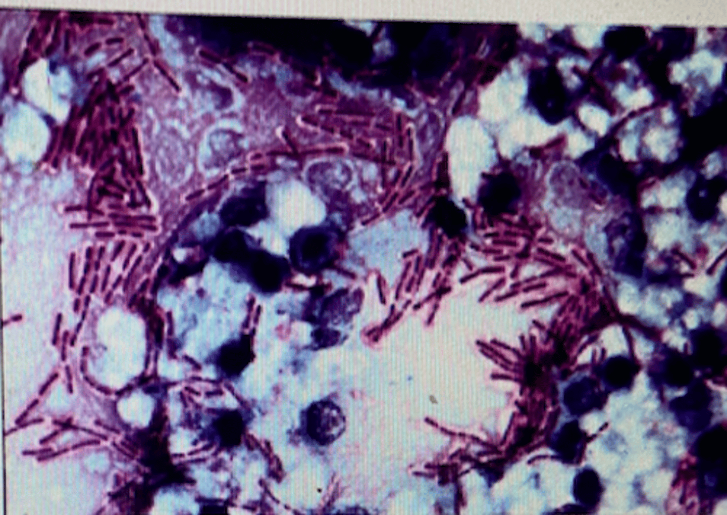 <p>What is the diagnosis for a blood smear from a bull that has died suddenly?</p><p>a. Black disease</p><p>b. IBR</p><p>c. Blackleg</p><p>d. Anthrax</p><p>e. Haemorrhagic septicaemia</p>