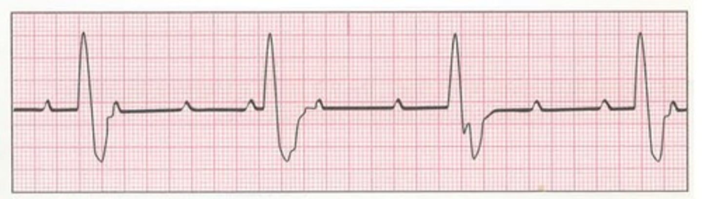 <p>AV dissociation (consistent p-p interval &amp; consistent R-R interval, but the two are not related)</p>